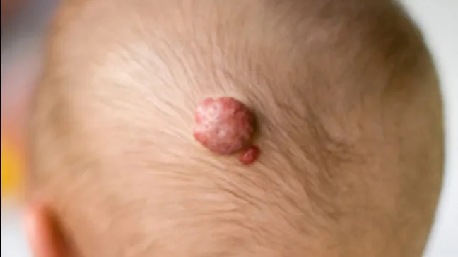 Hemangioma, a vascular tumor (Internet downloaded)