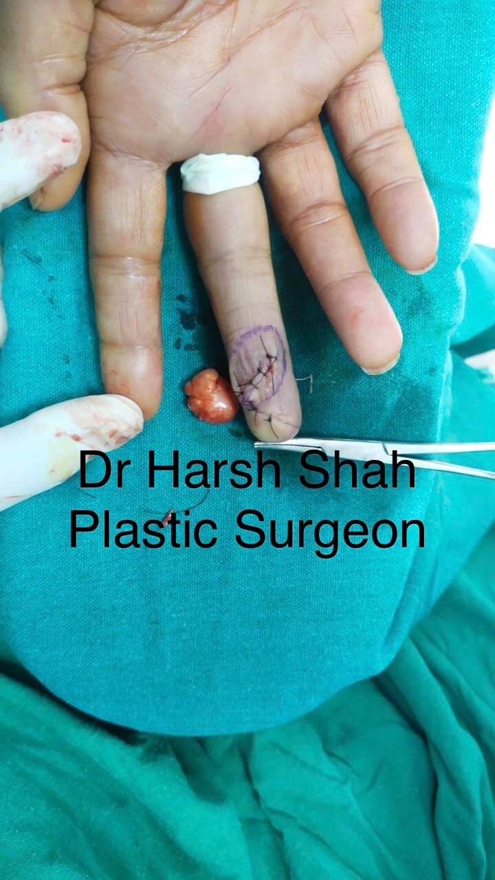 GCT (tumor of tendon) 