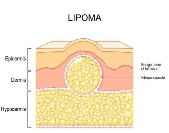 Microscopic sketch of location of lipoma 