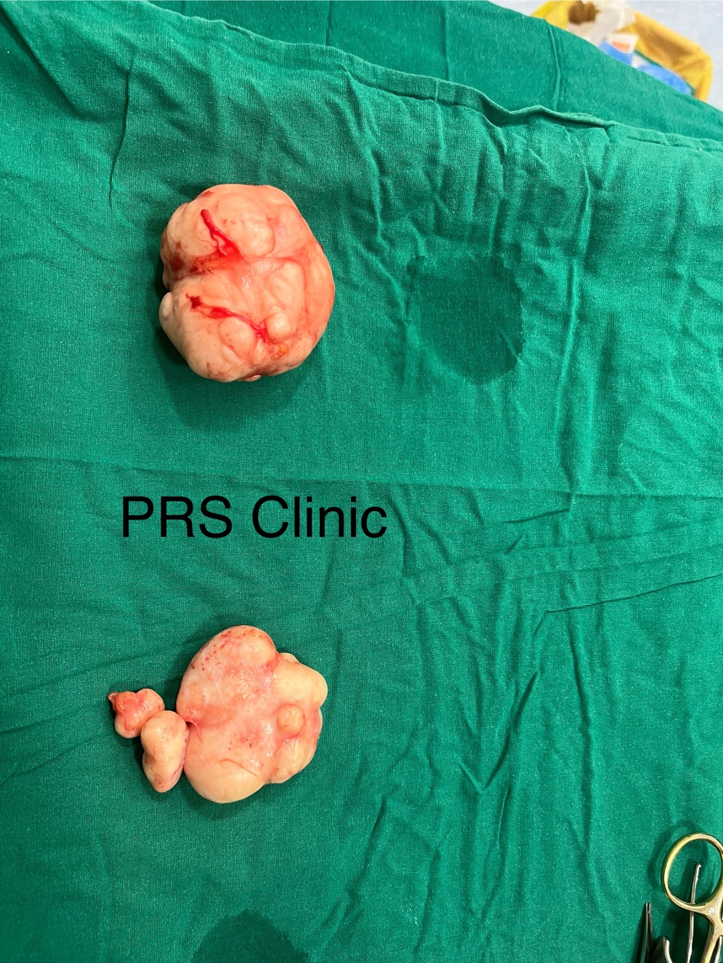 Lipoma swelling: appreciate the fatty component 