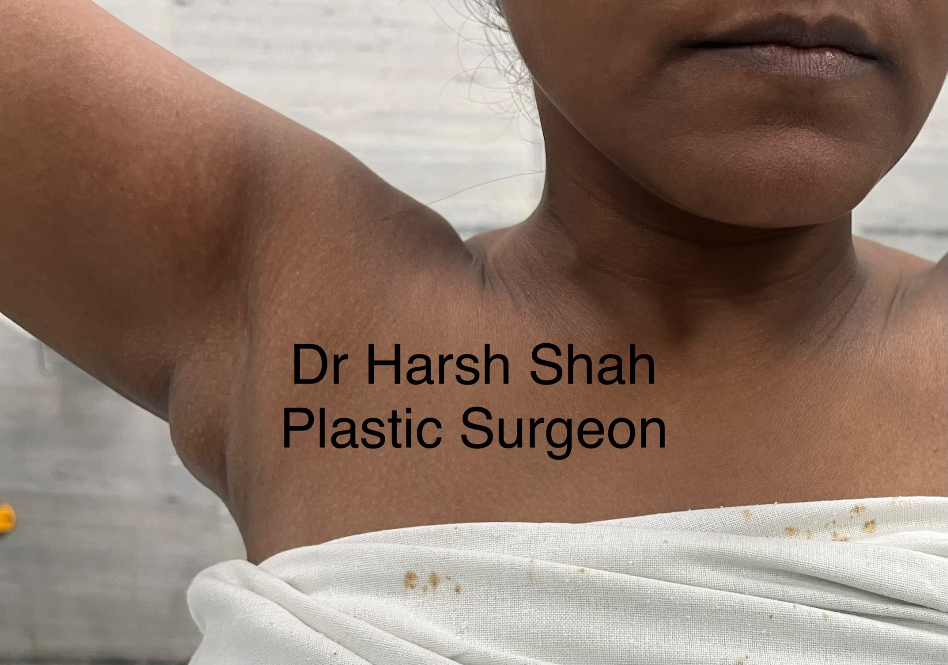 Axillary breasts presenting as lipoma
