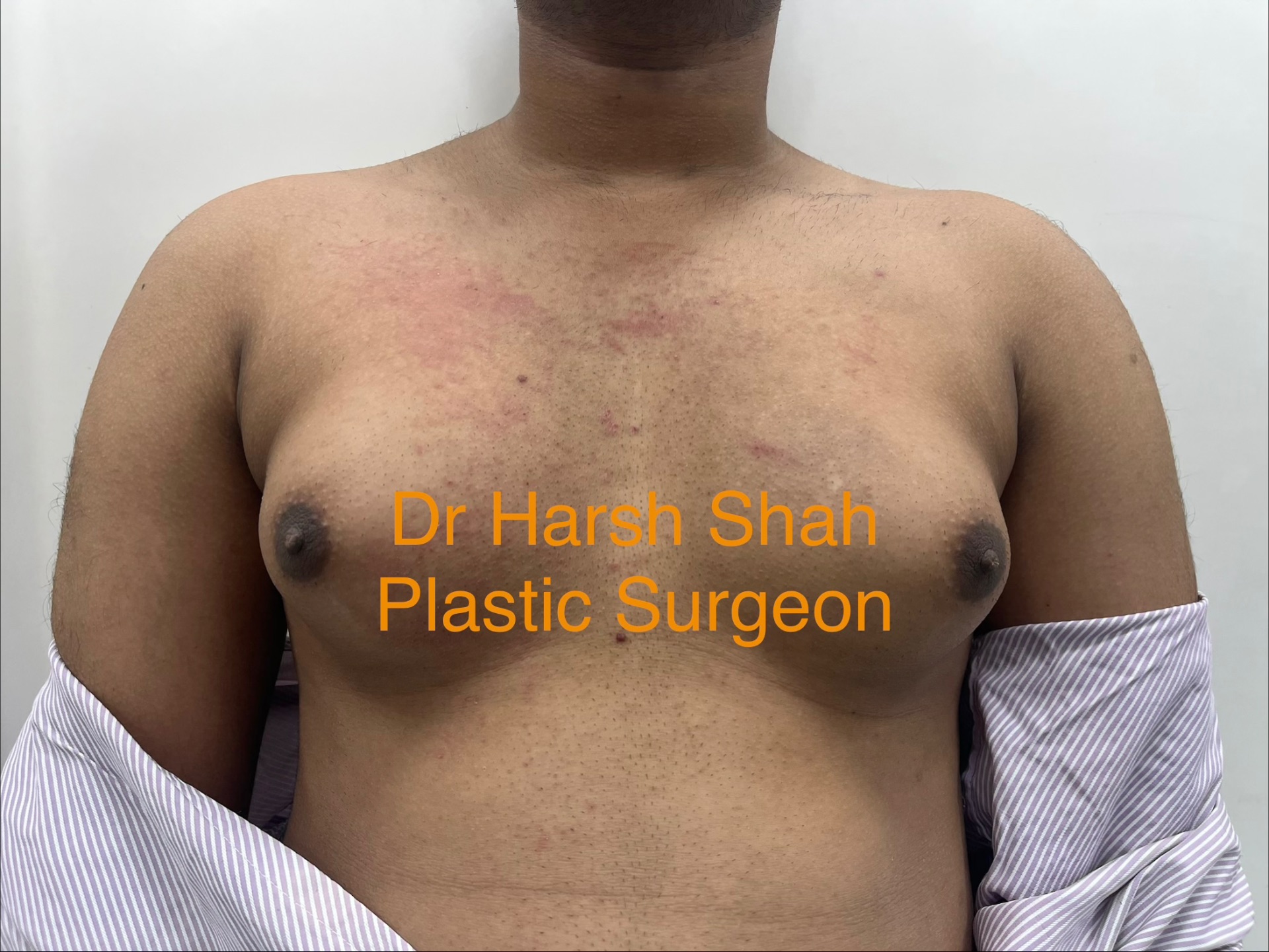 Bilateral Grade 2 gynecomastia