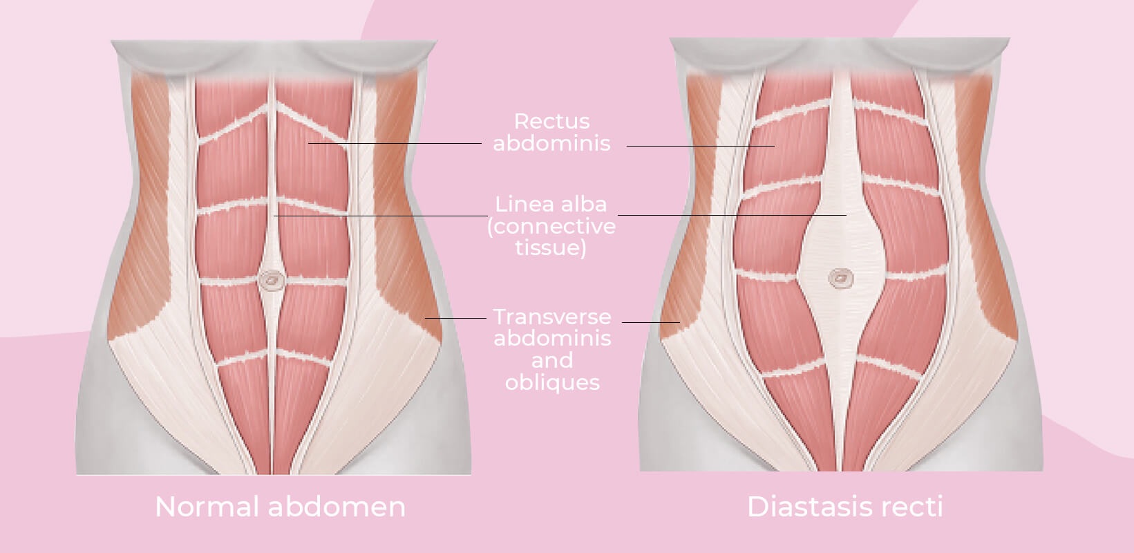 Rectal muscle separation viz Diastasis