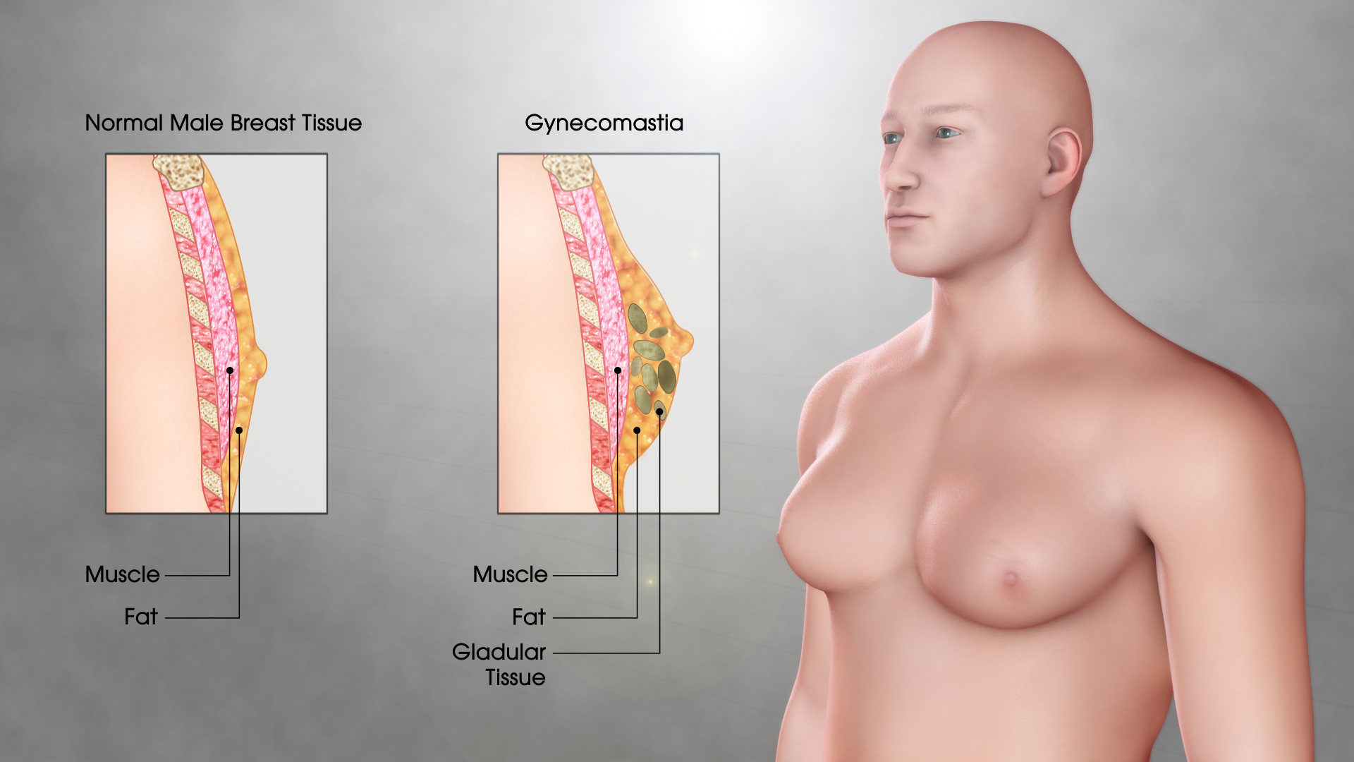 Gynaecomastia Surgery Guide