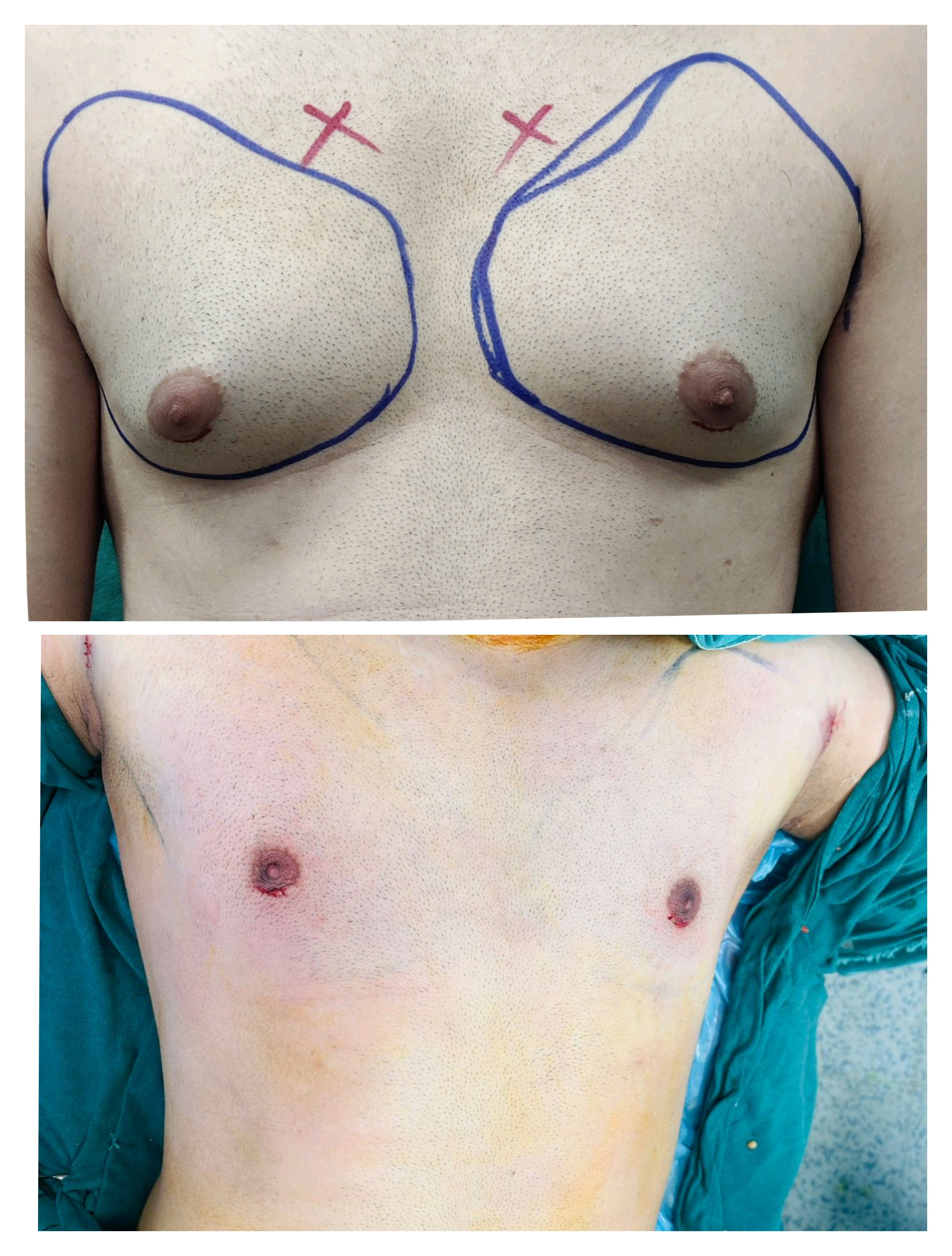 Before and After - Our on table Results of 360° 4Dx Technique