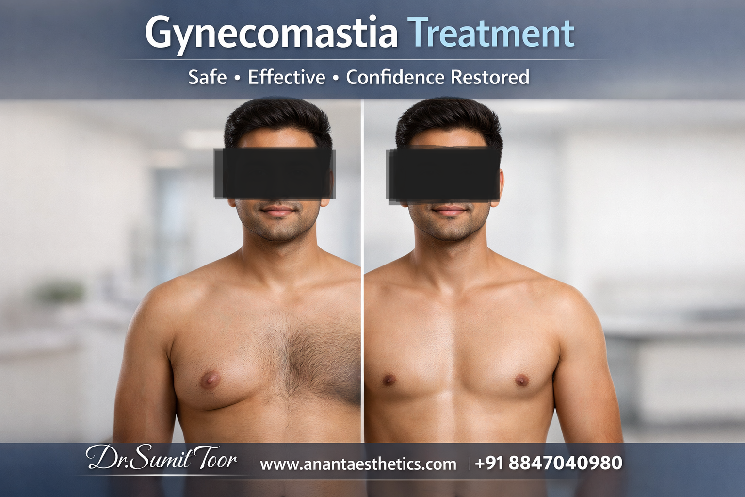 Gynecomastia Surgery Guide