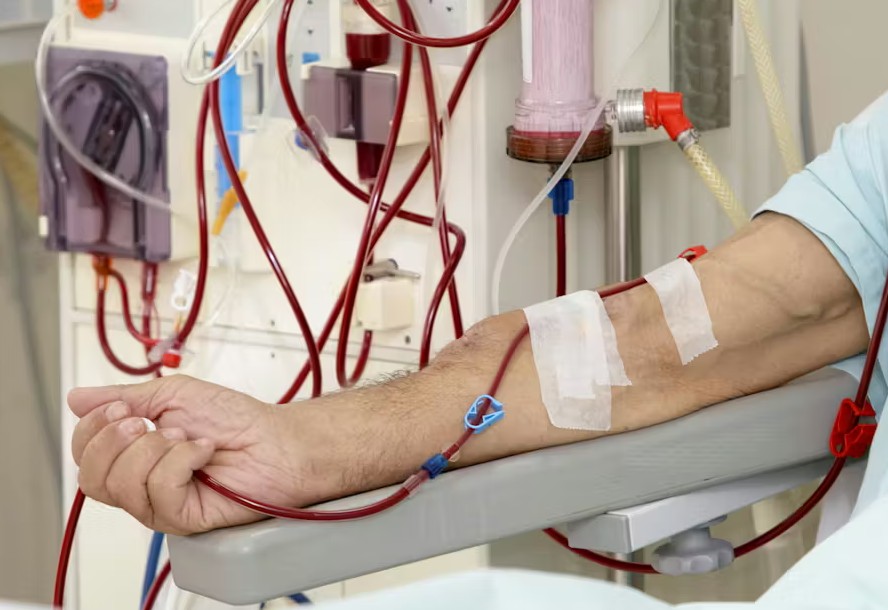 Hemodialysis from AVF