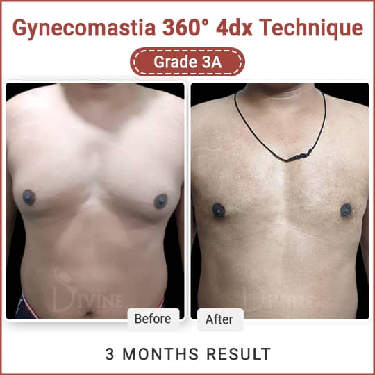 Before and After Gynecomastia - 3 months result