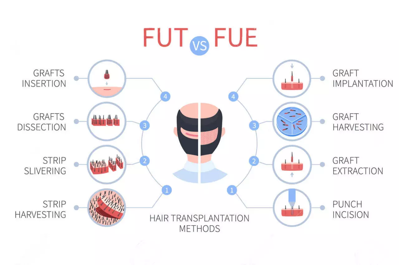 Infographics on FUT vs FUE