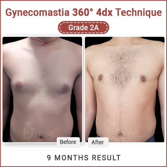 Before and After Gynecomastia - 9 months result