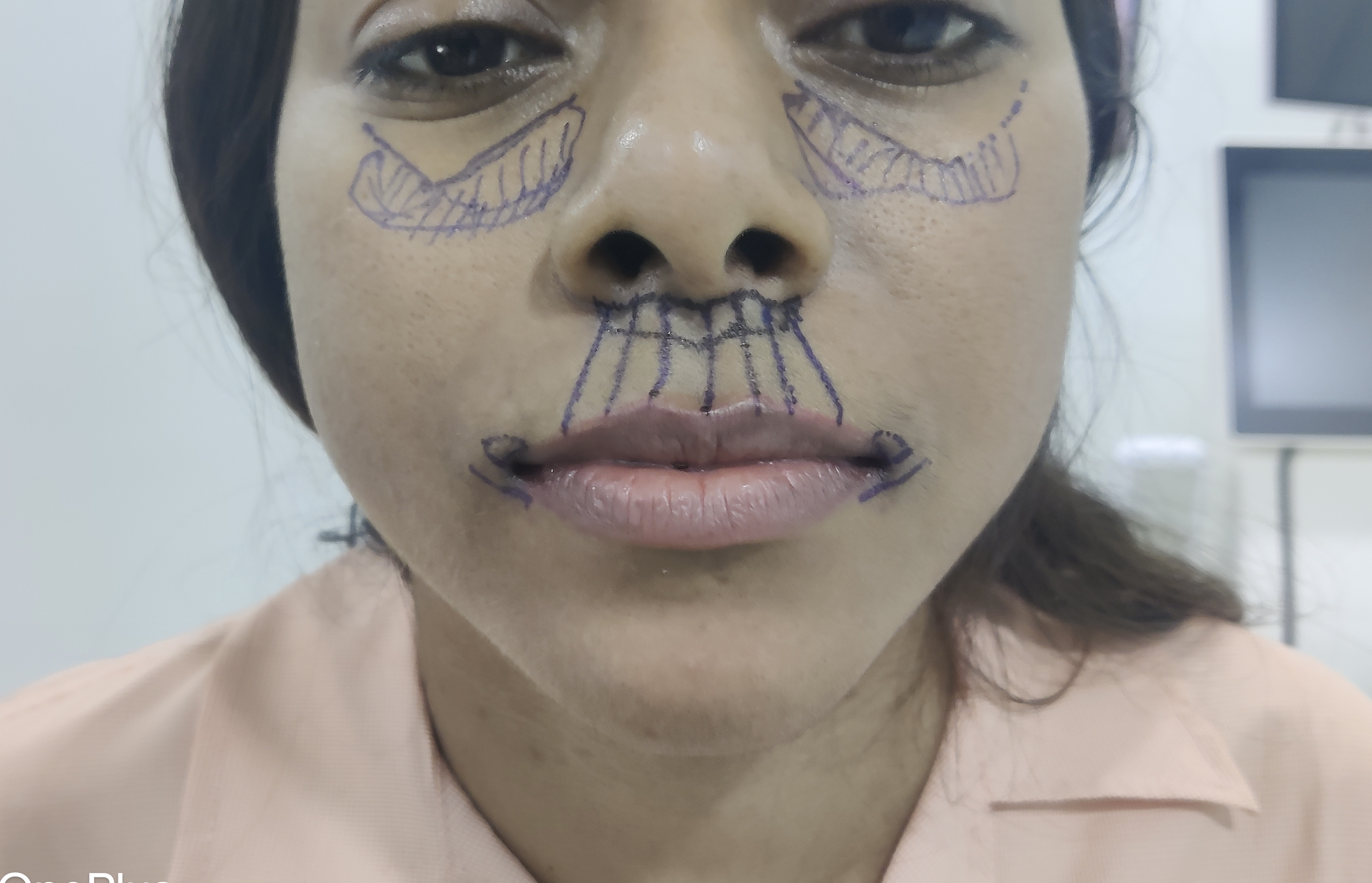 Pre operative marking 