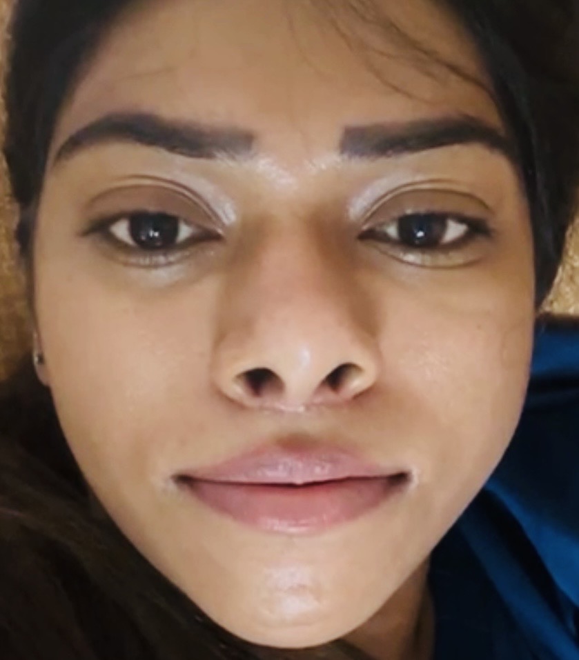 Perfect youthful lip after surgery 