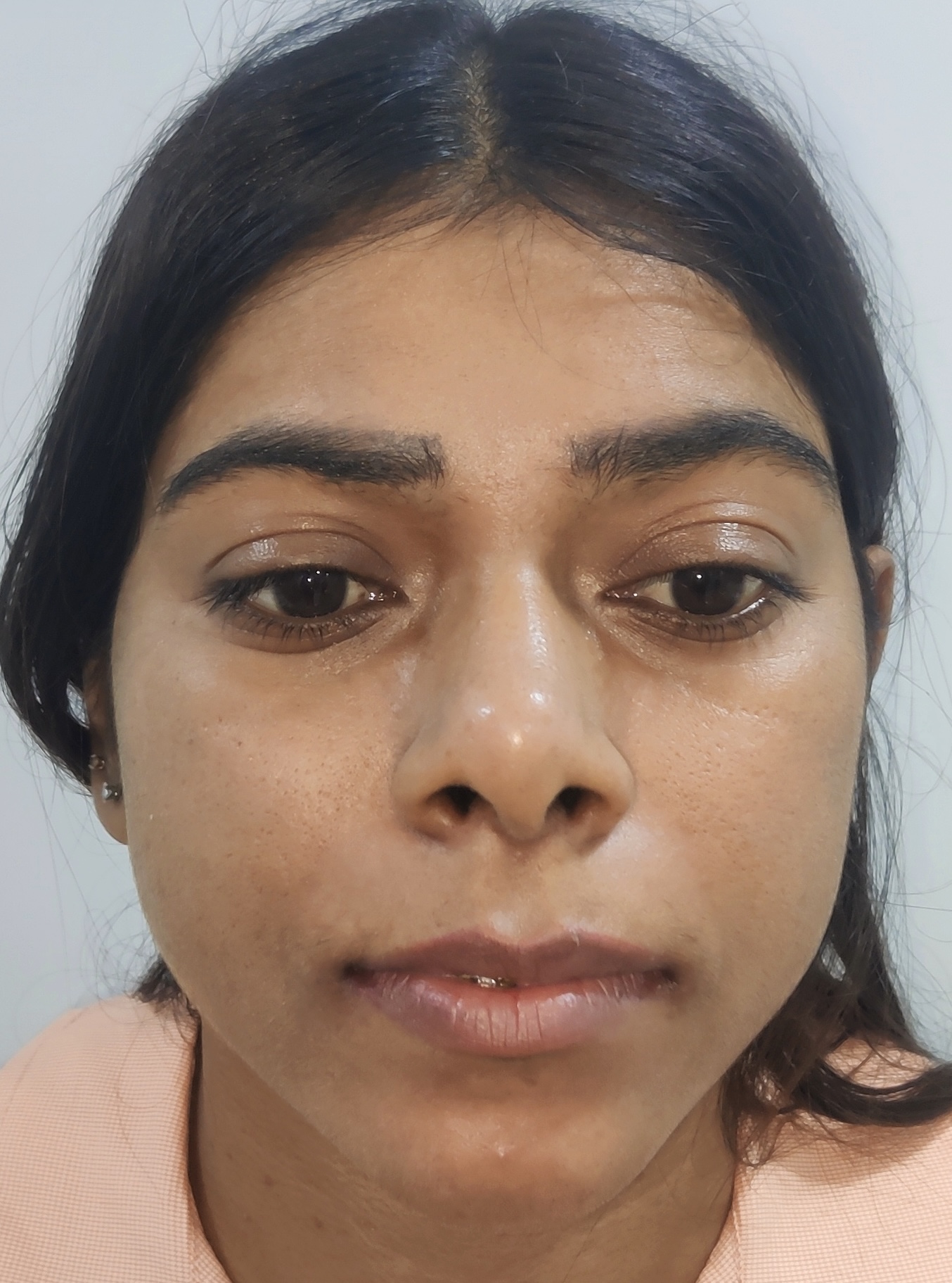 Lip Lift for Permanent Youthful Look