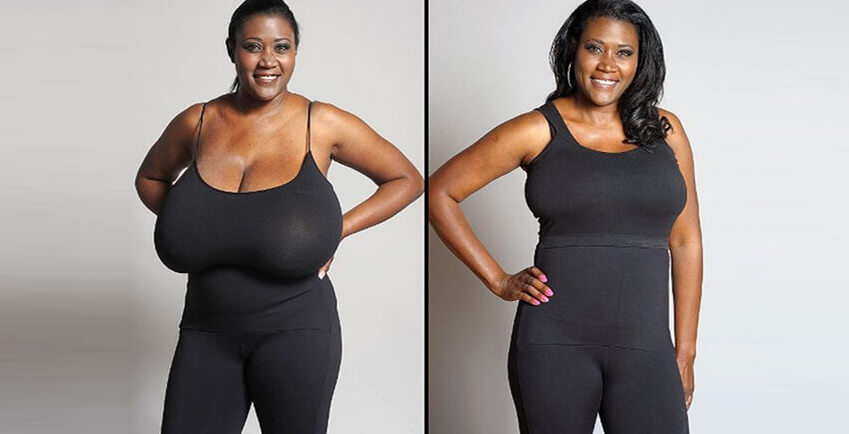 Breast Reduction Surgery