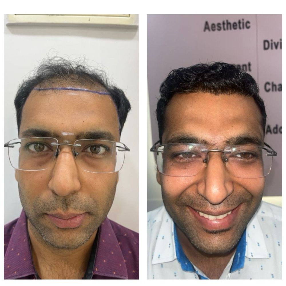 Why Your Hair Transplant Failed