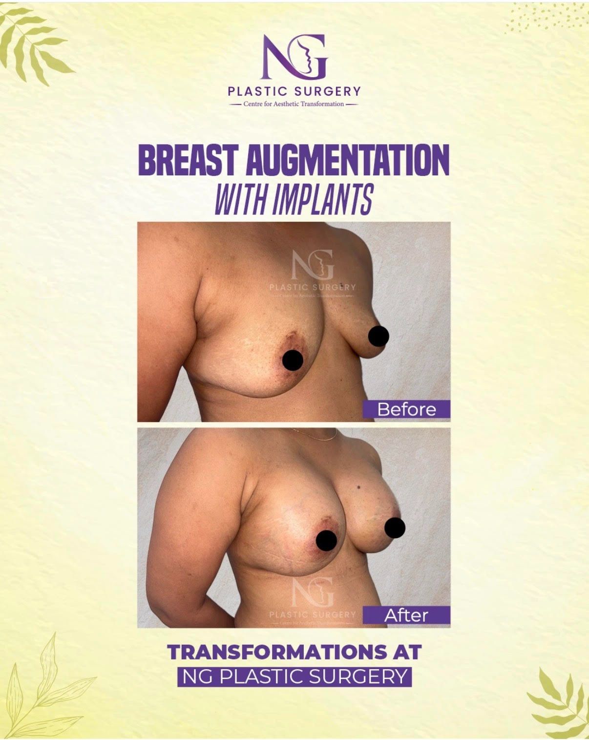 BREAST IMPLANT SURGERY AT NG PLASTIC SURGERY CENTRE, AHMEDABAD