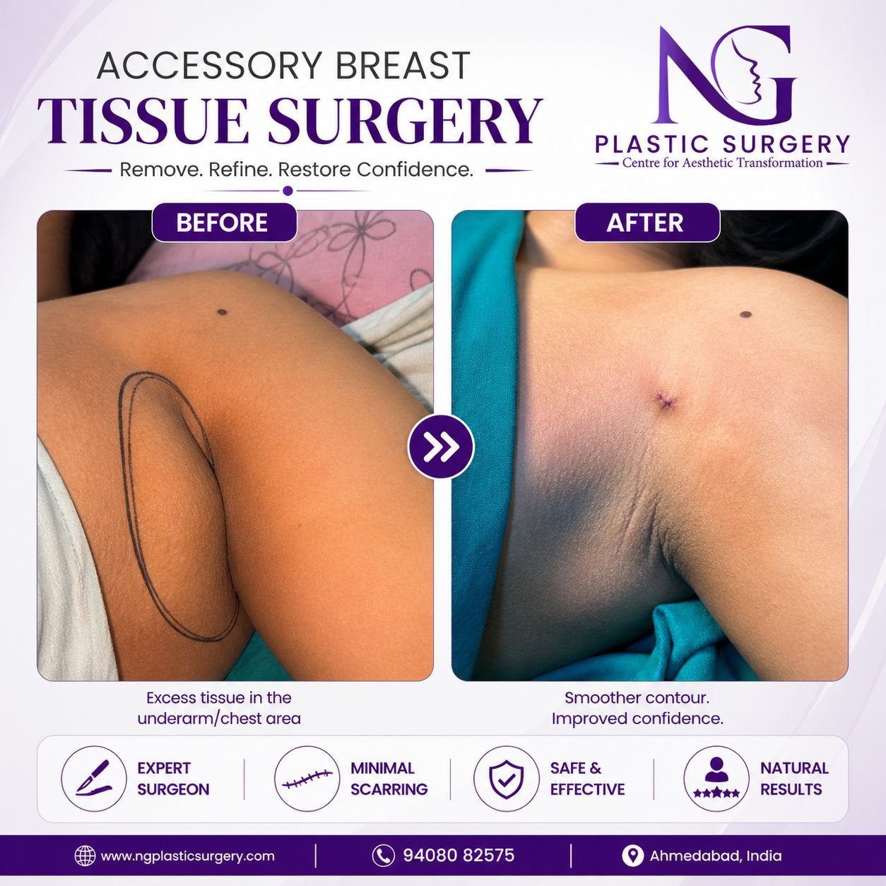 accessory breast tissue surgery in ahmedabad