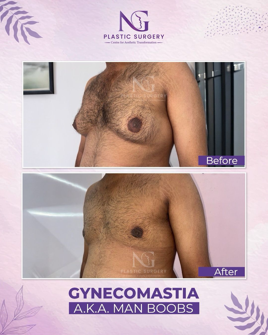 gynecomastia surgery at NG Plastic Surgery Centre in Ahmedabad