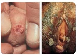 Genital Warts