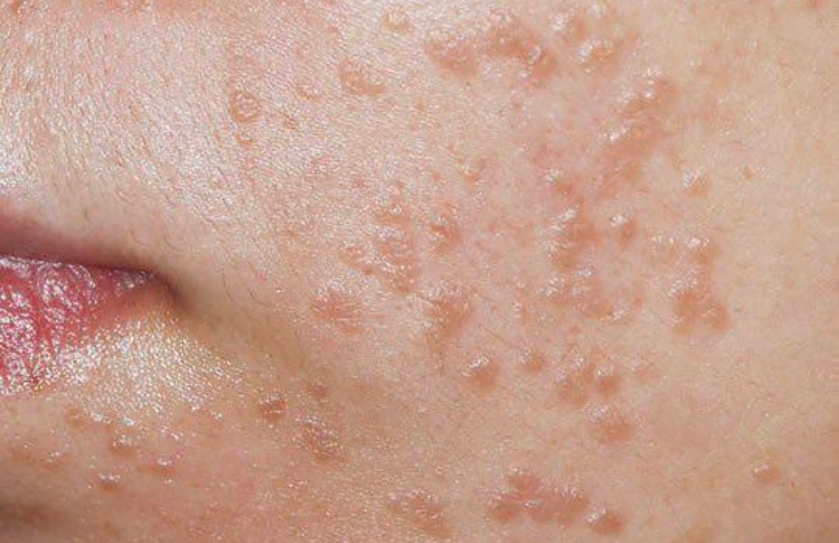 Flat Warts
