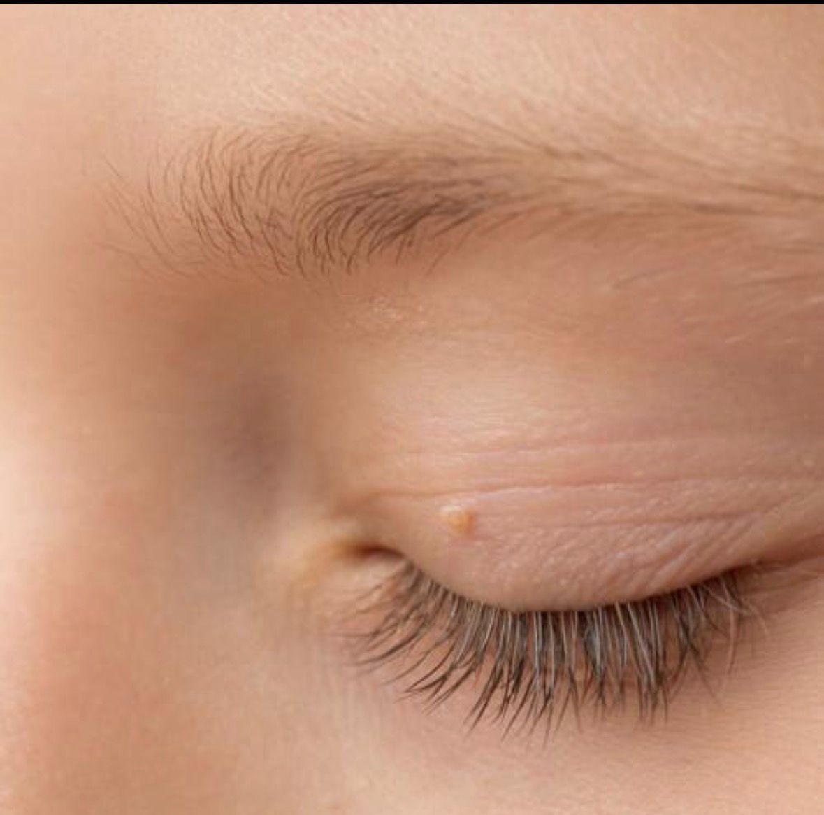 Filiform Warts