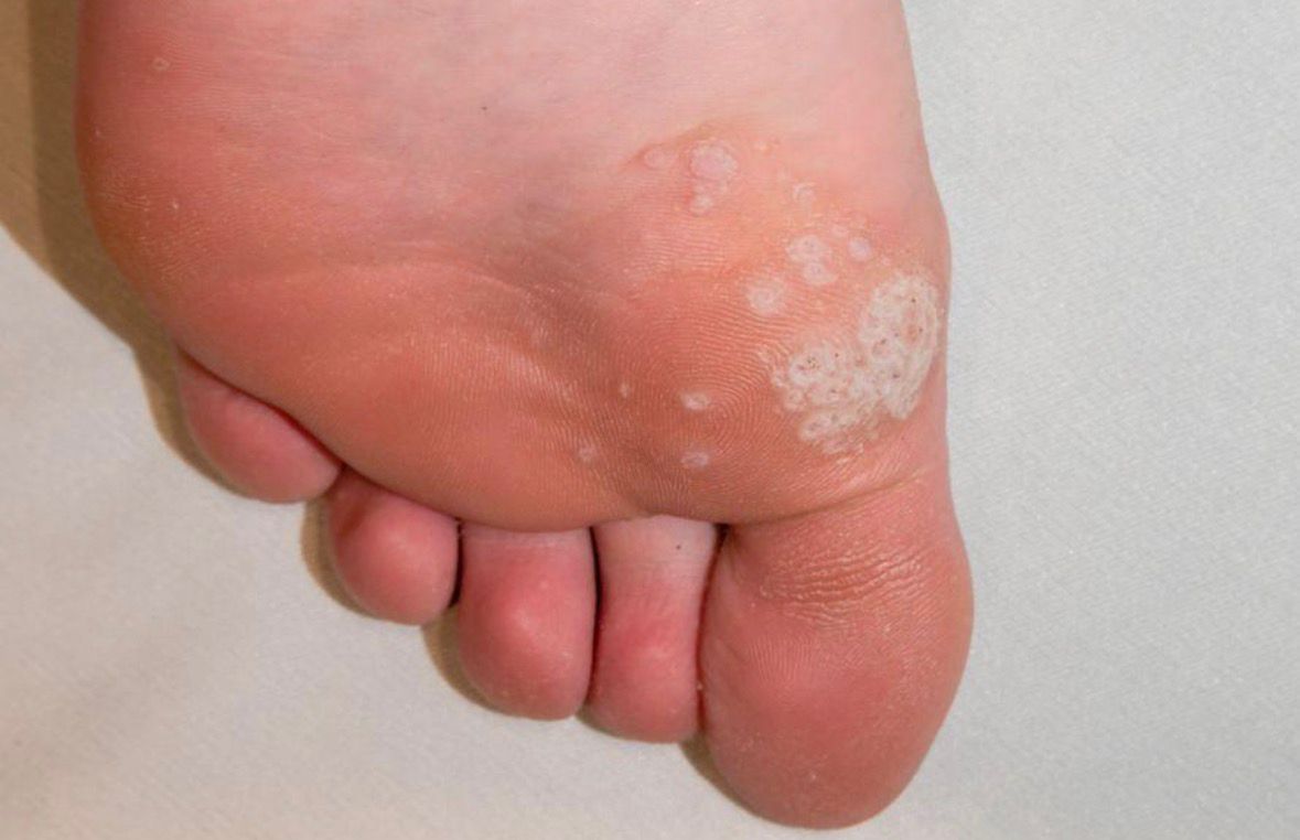 Planter Warts