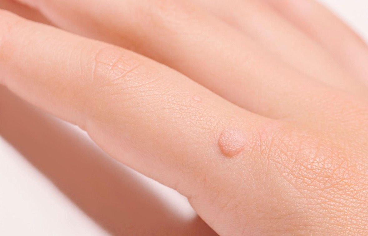 Verruca Vulgaris (Common Warts)
