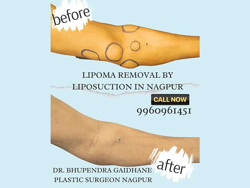 hybrid lipoma removal technique liposuction micro excision before and after Nagpur