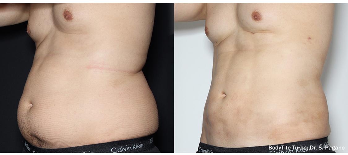 Complete change of abdomen shape