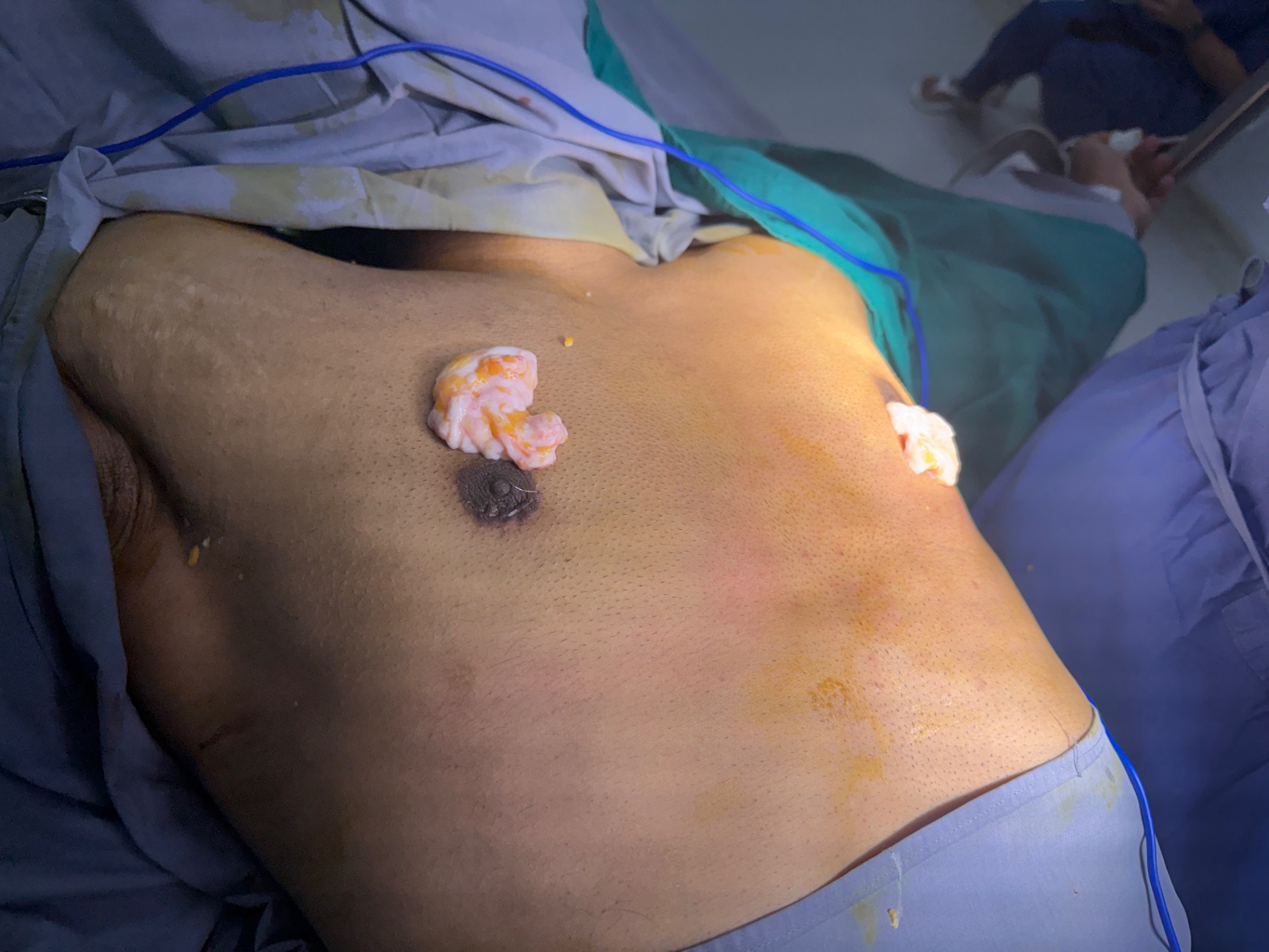 Same patient - Both glands removed by Plastic Surgeon completely , No visible scar on Operation table 