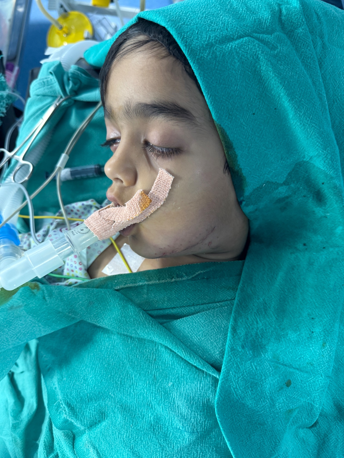 Same patient revision suturing done by Plastic Surgeon 