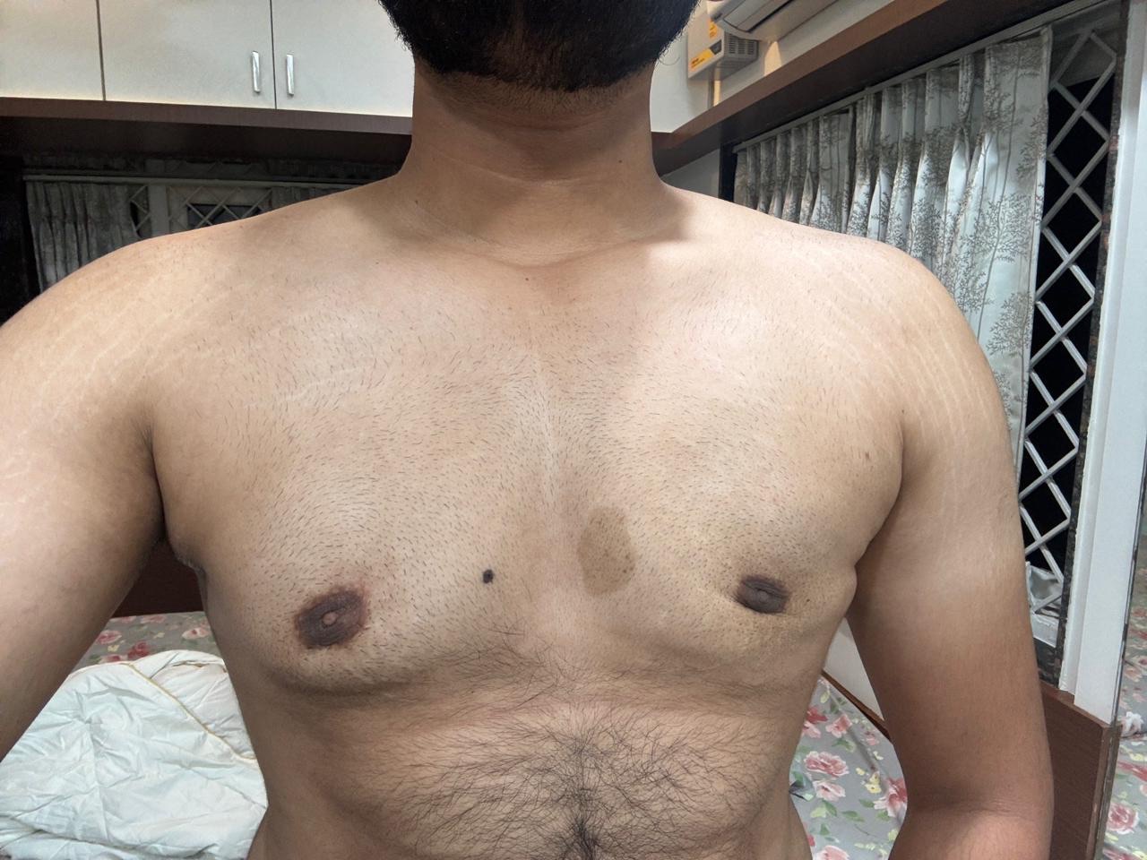 Patient operated by Normal surgeon. Notice the recurrence on right side and contours irregularities on left side 