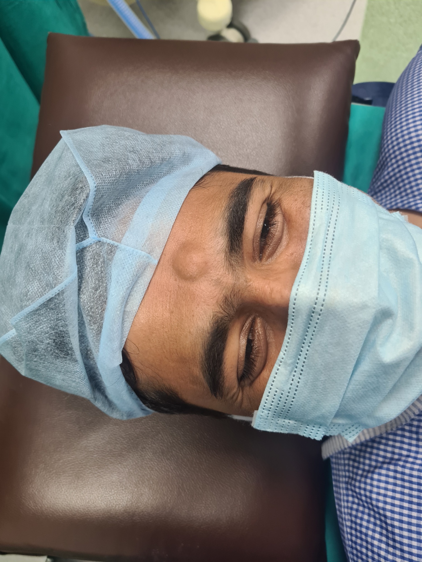 Lipoma can be small & single 