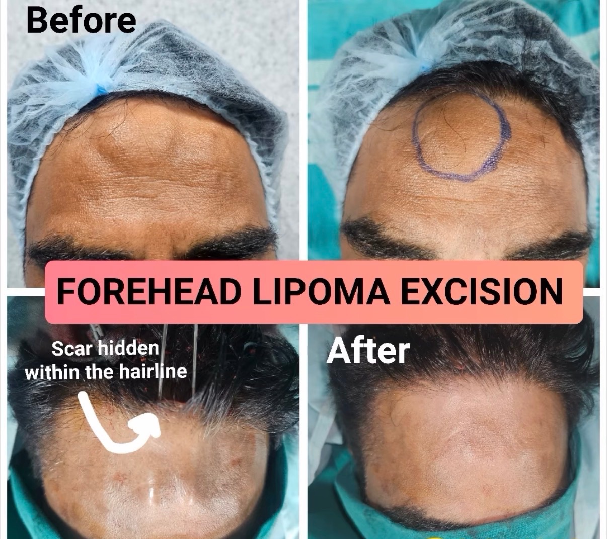 We use multiple approaches to hide scars and give best results 