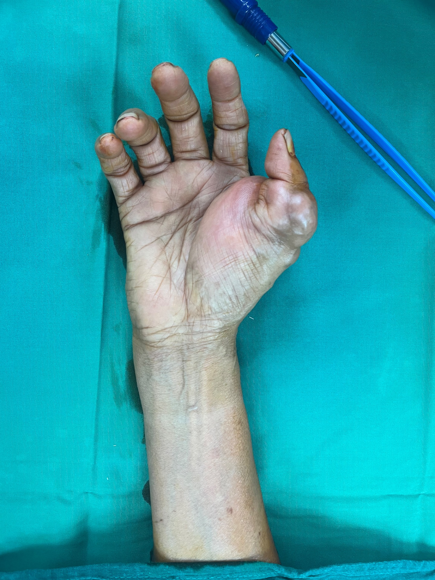 In some patients it can occur in hand also 