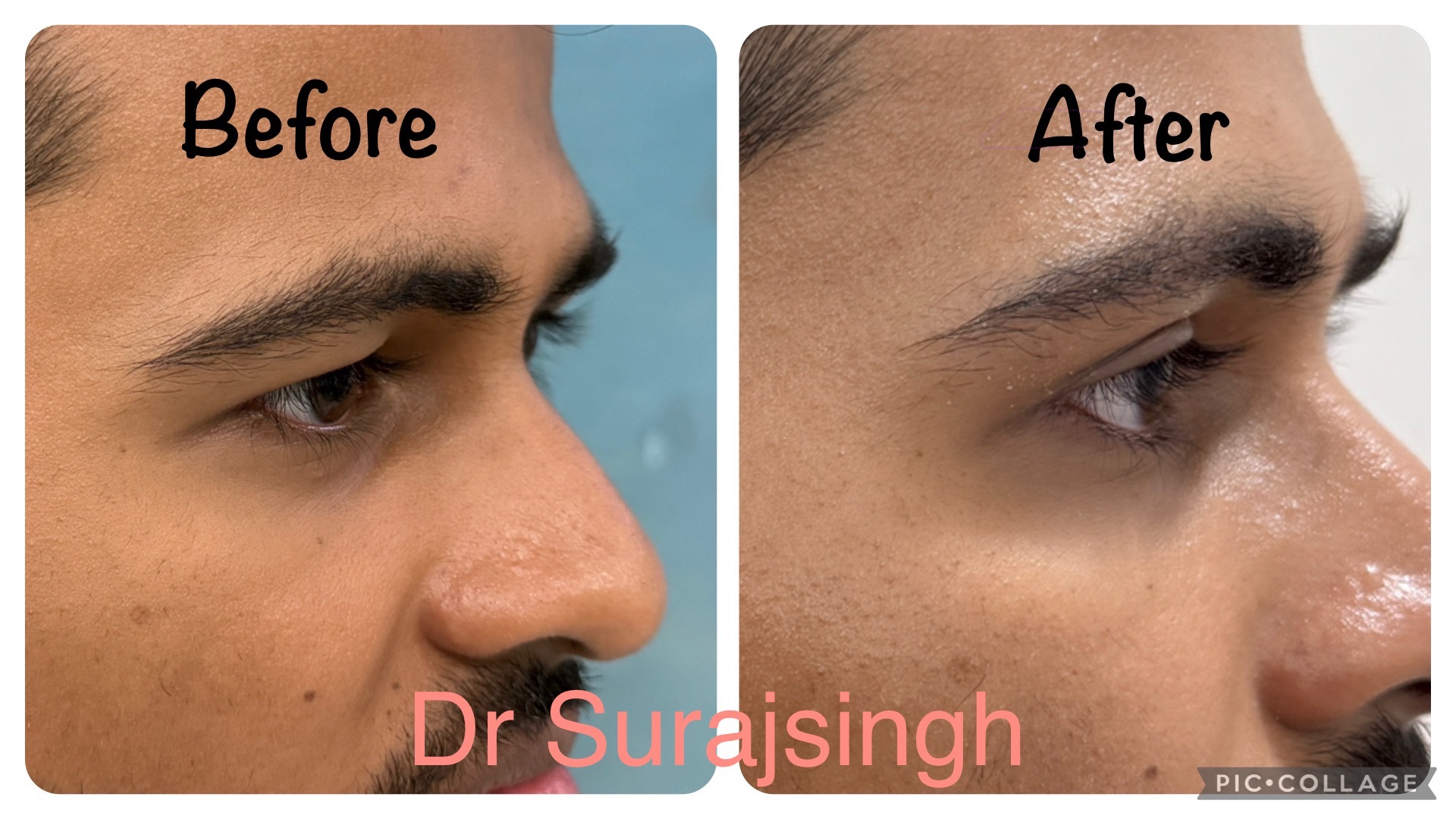 See the upper lid fold 