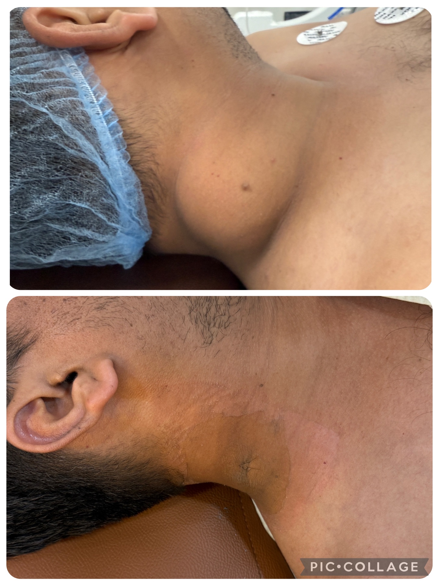 Plastic Surgery can remove huge lipomas almost scarless