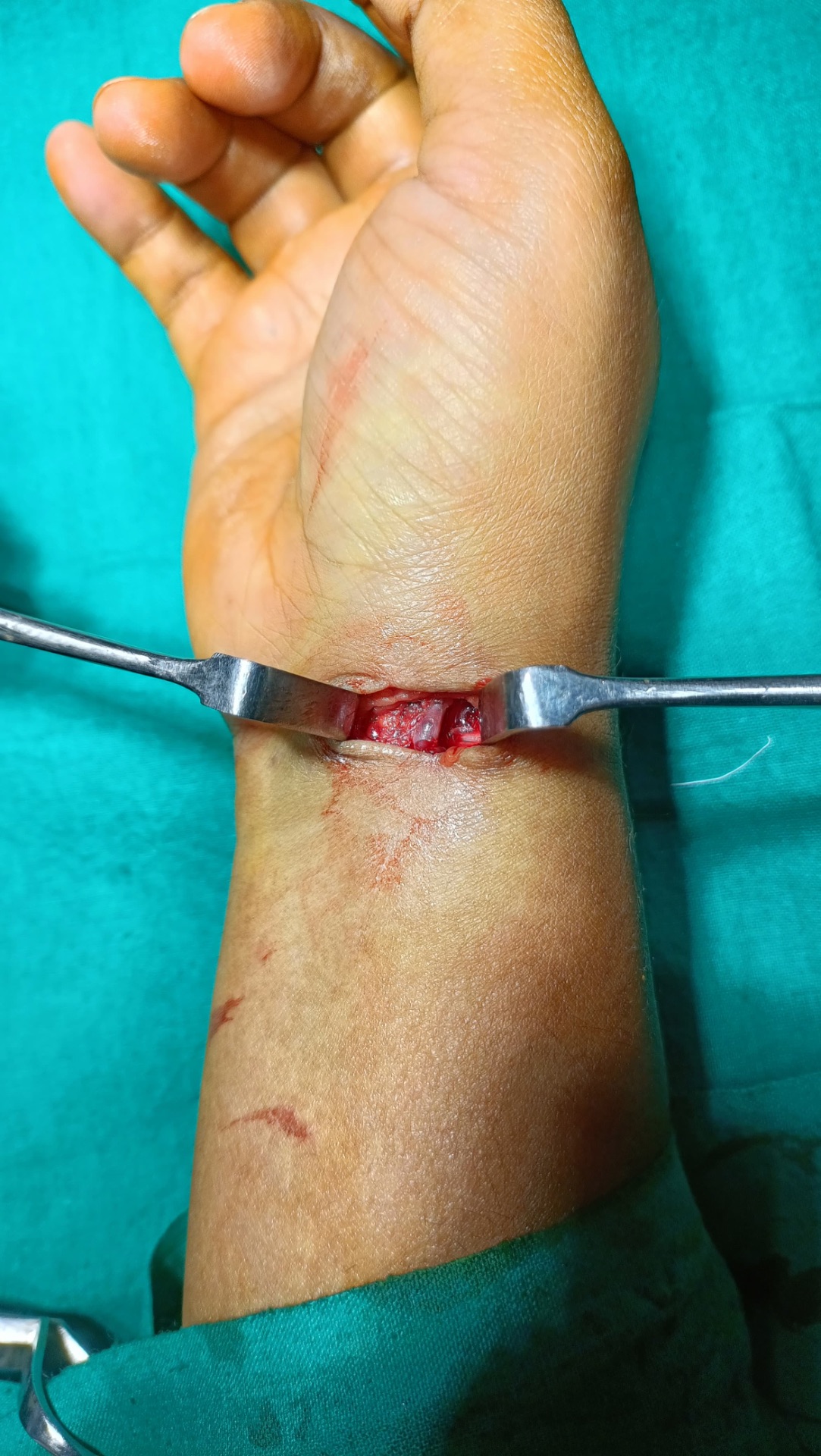 Plastic surgery can save all vessels and nerves 