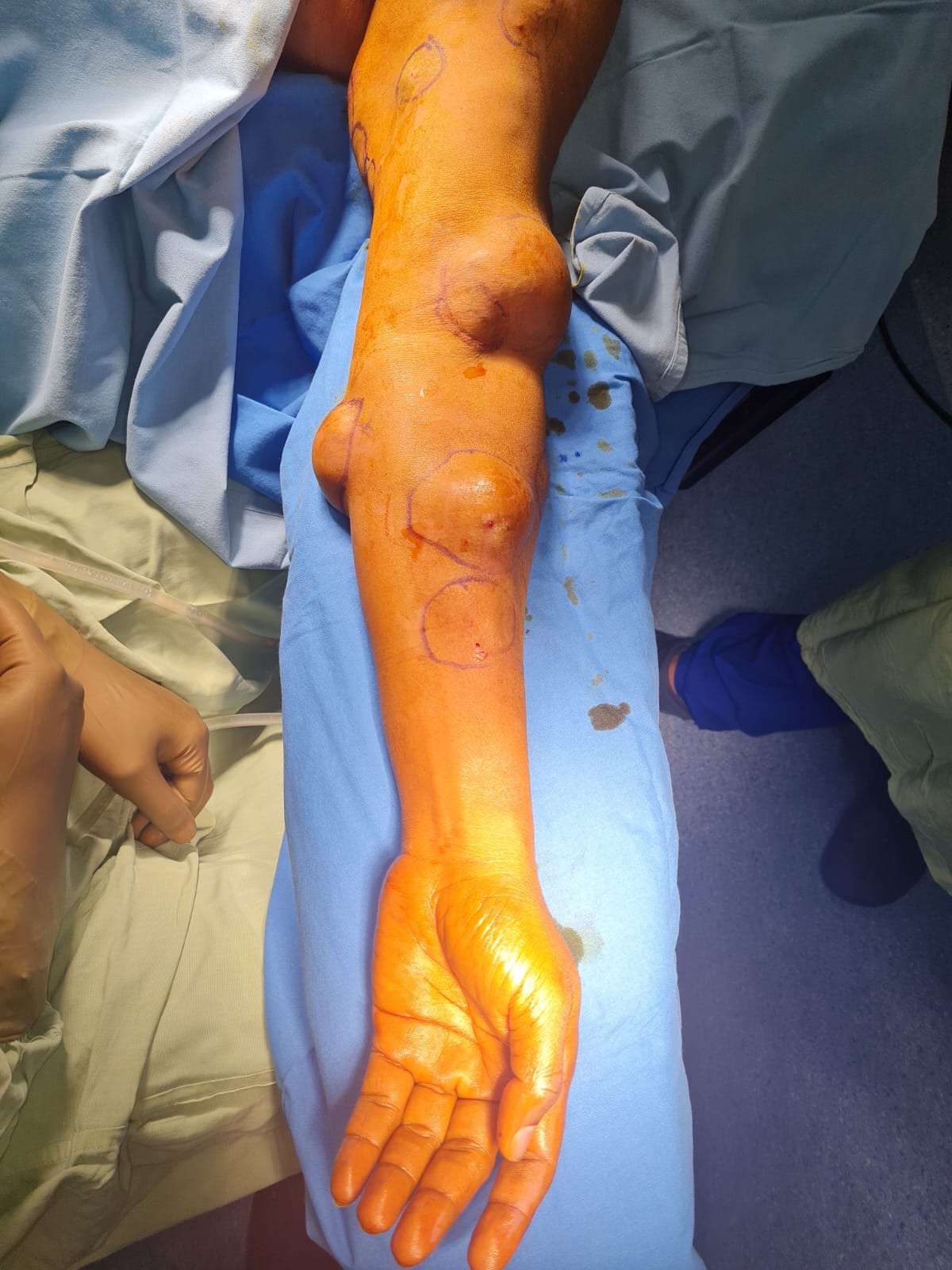 See the multiple big lipomas on upper limb