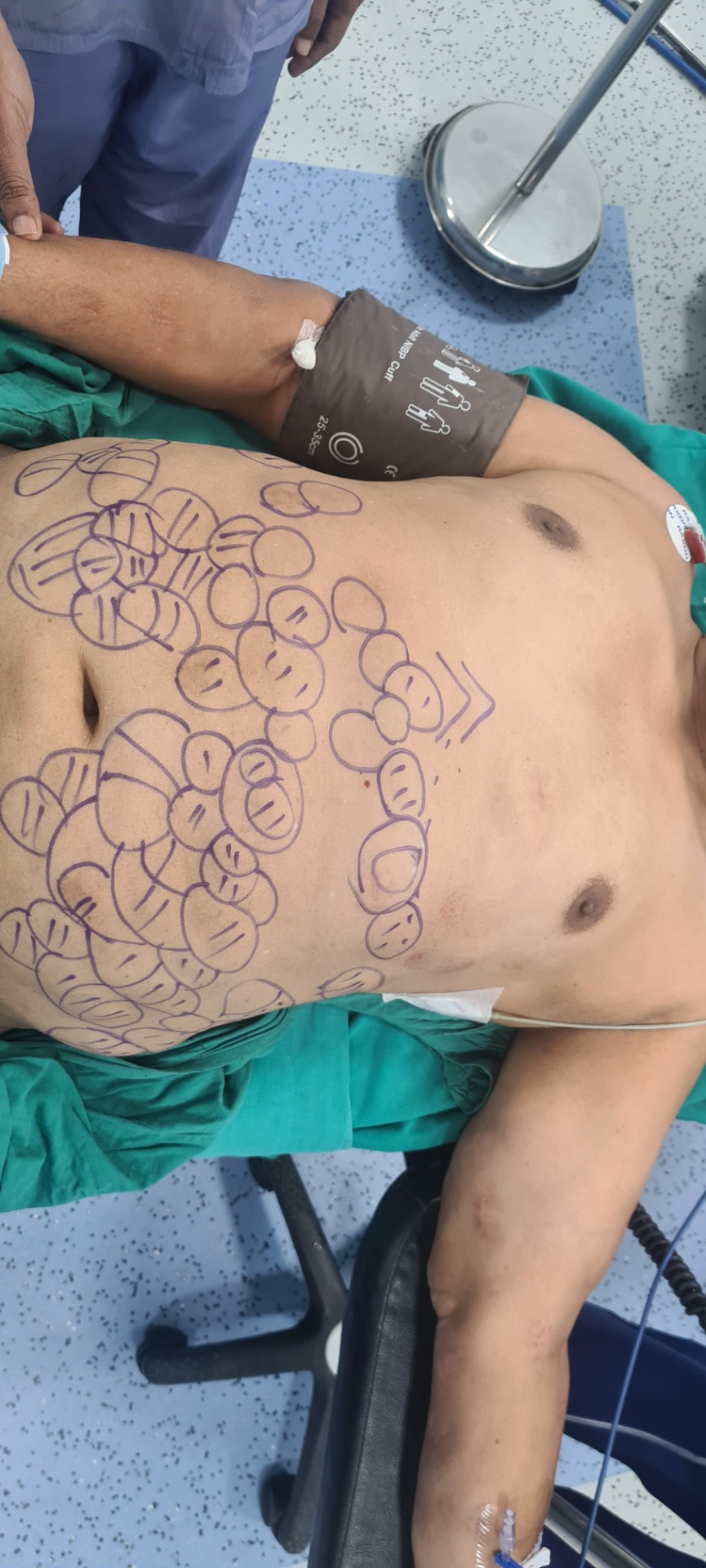 Lipoma can cover whole abdomen and body also 