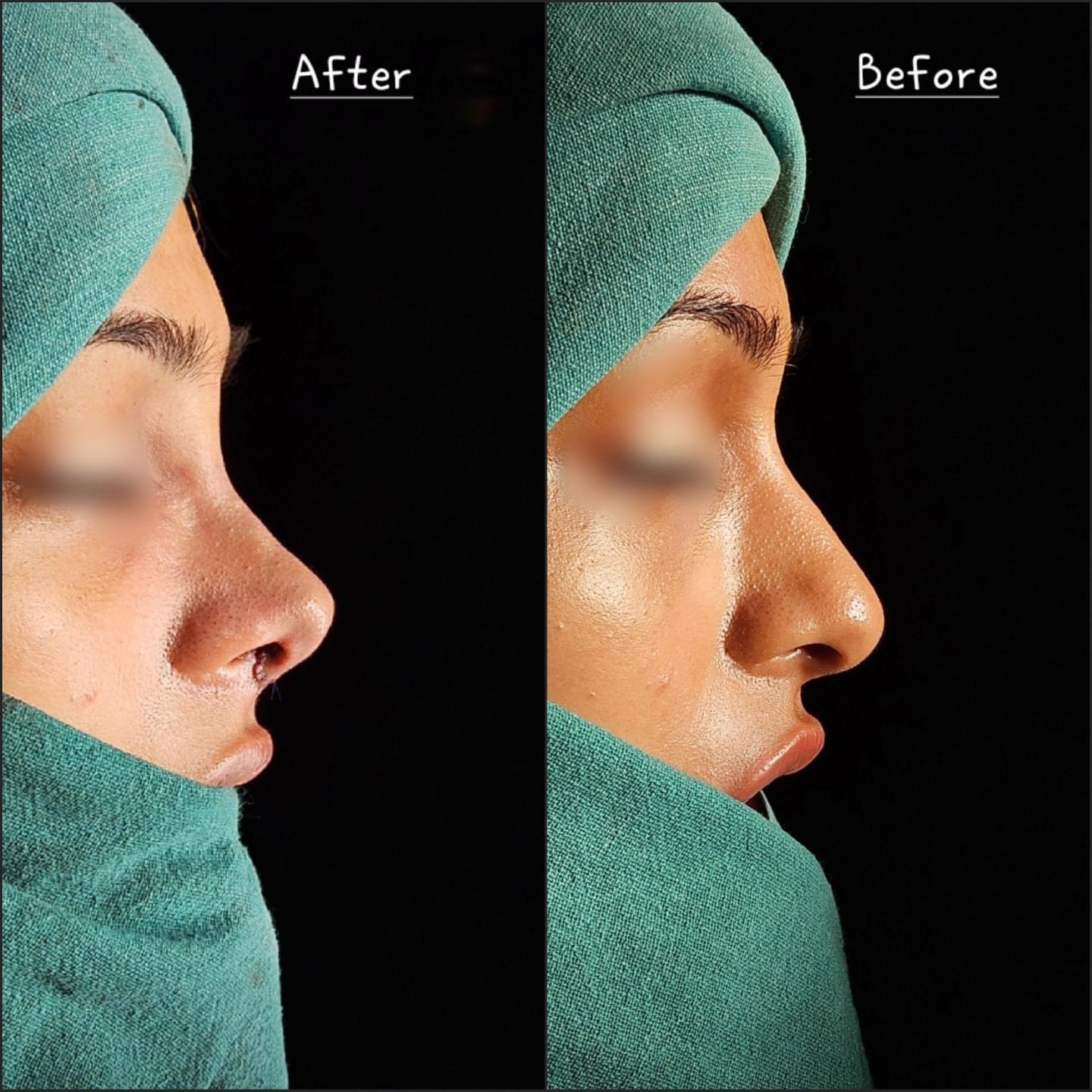 Surgical Rhinoplasty 