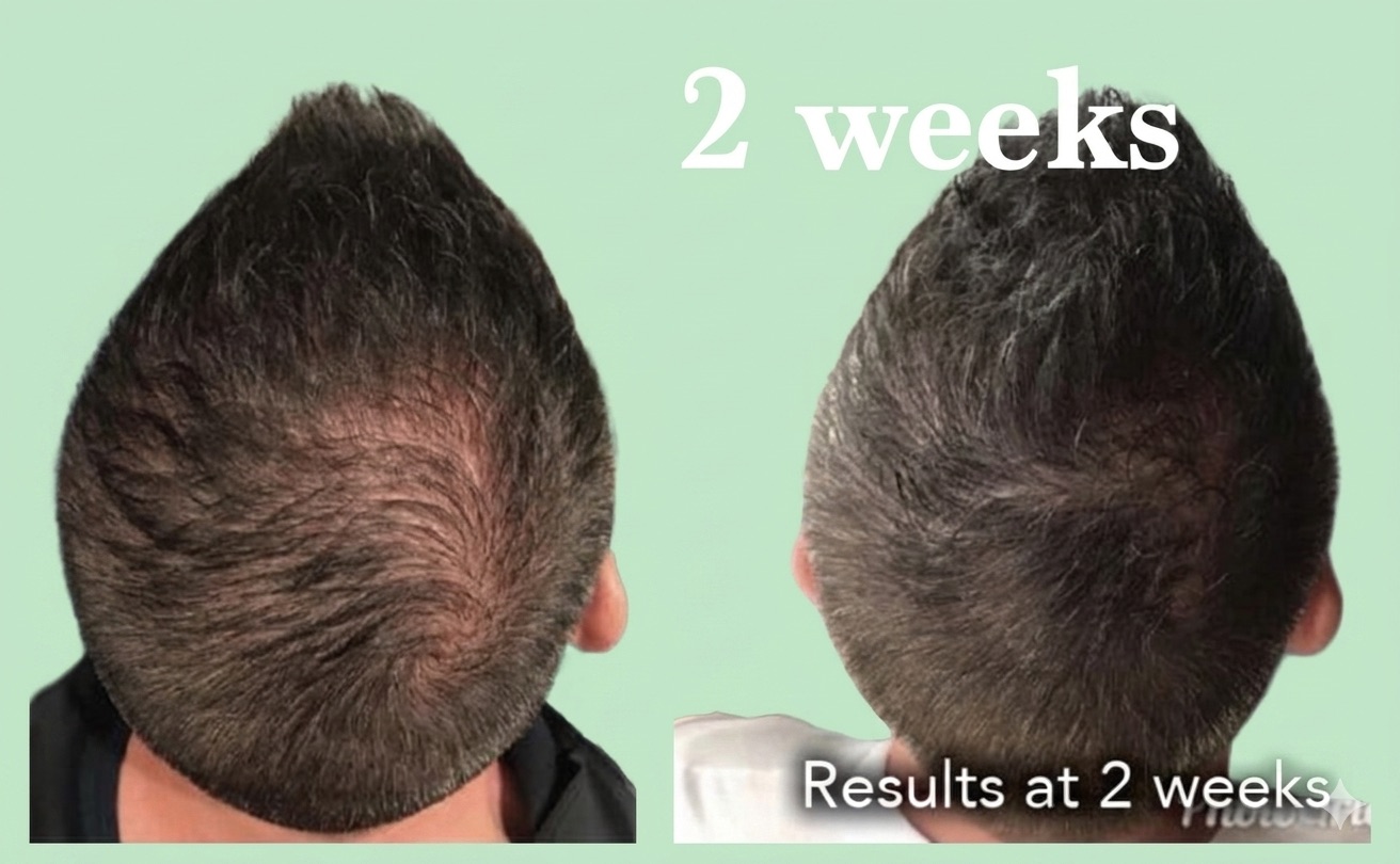 Results seen at 2 weeks 