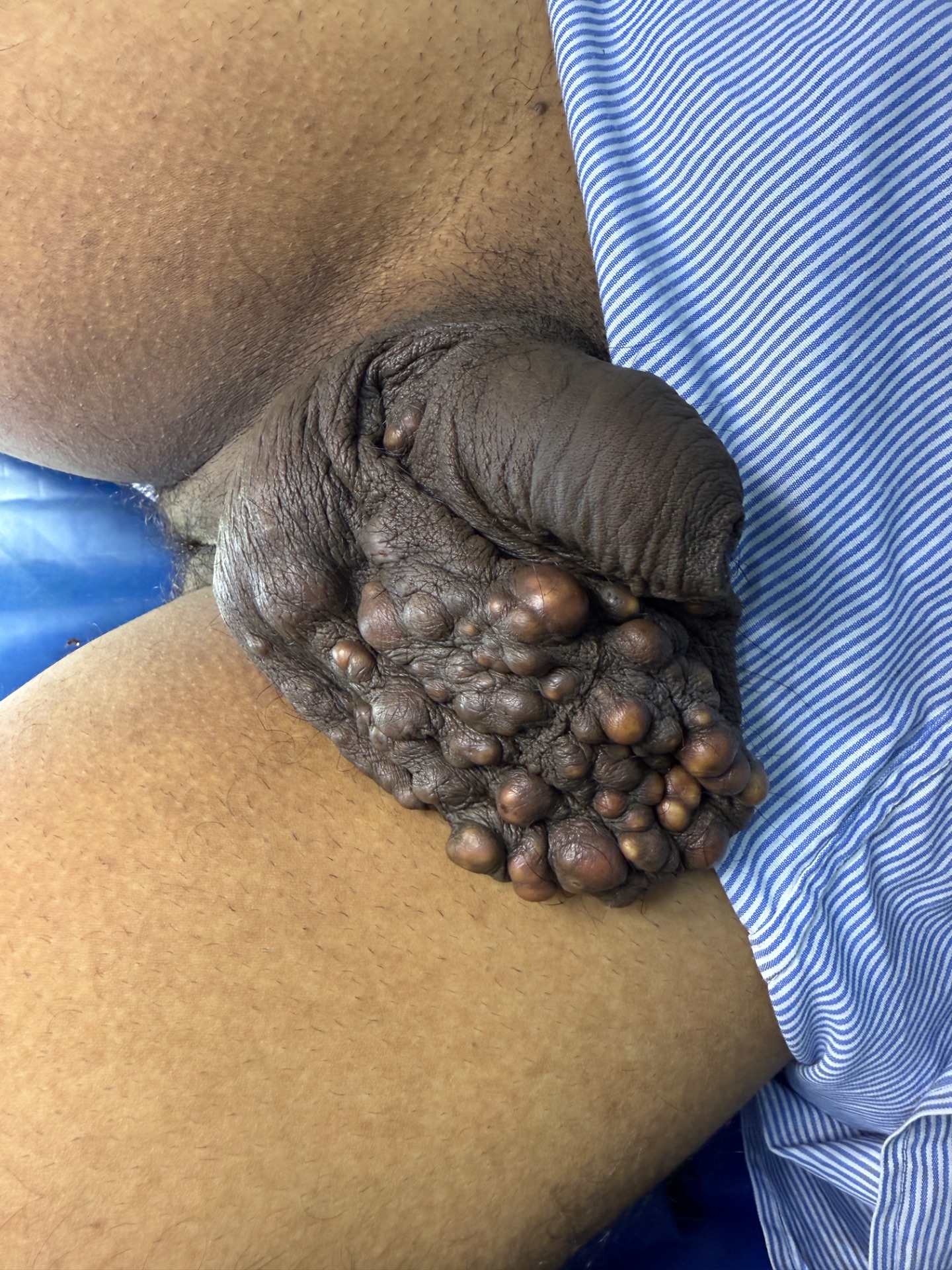 It can involve entire scrotum which is frustrating 