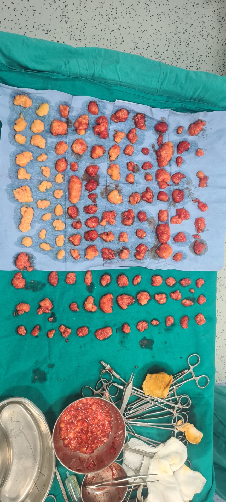 Multiple lipoma (108) excised through only small 5 holes