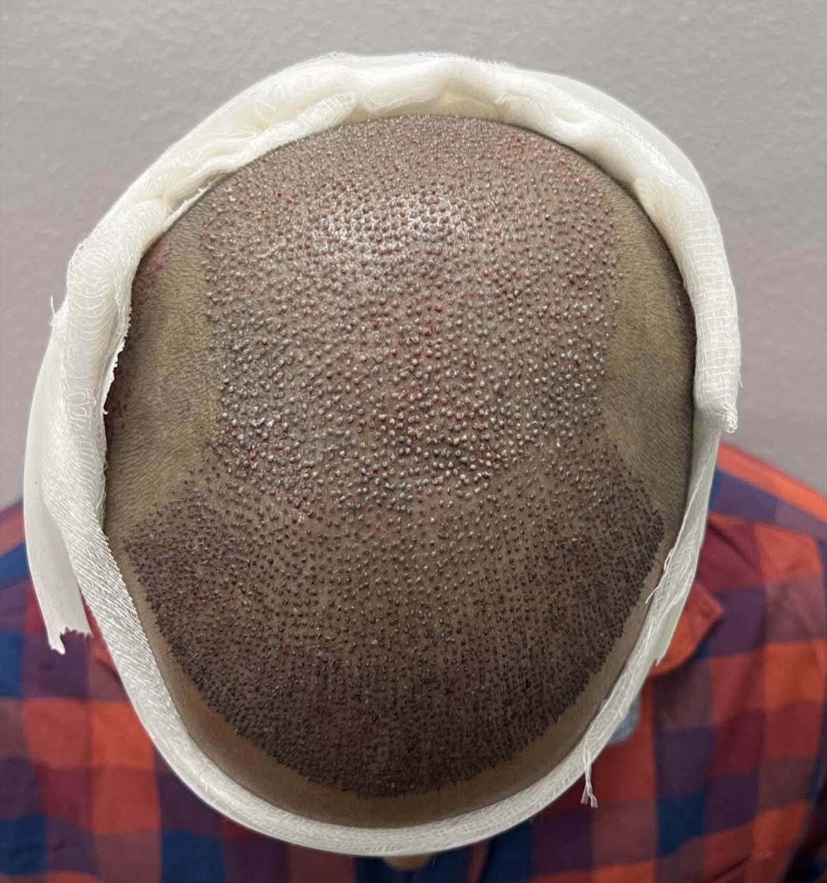 Maximum area can be covered with hair transplant 