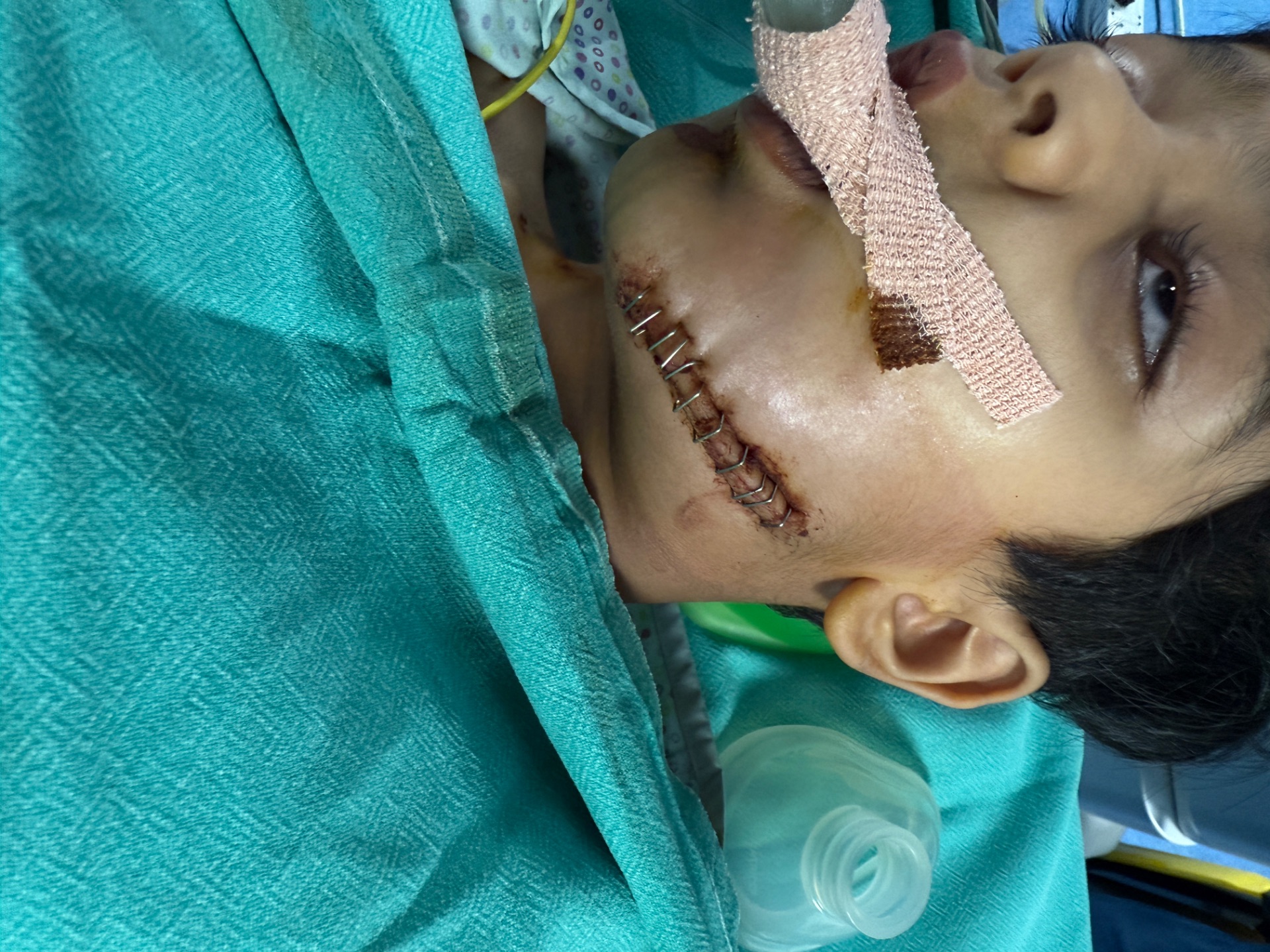 Sutures given by Normal Doctor 