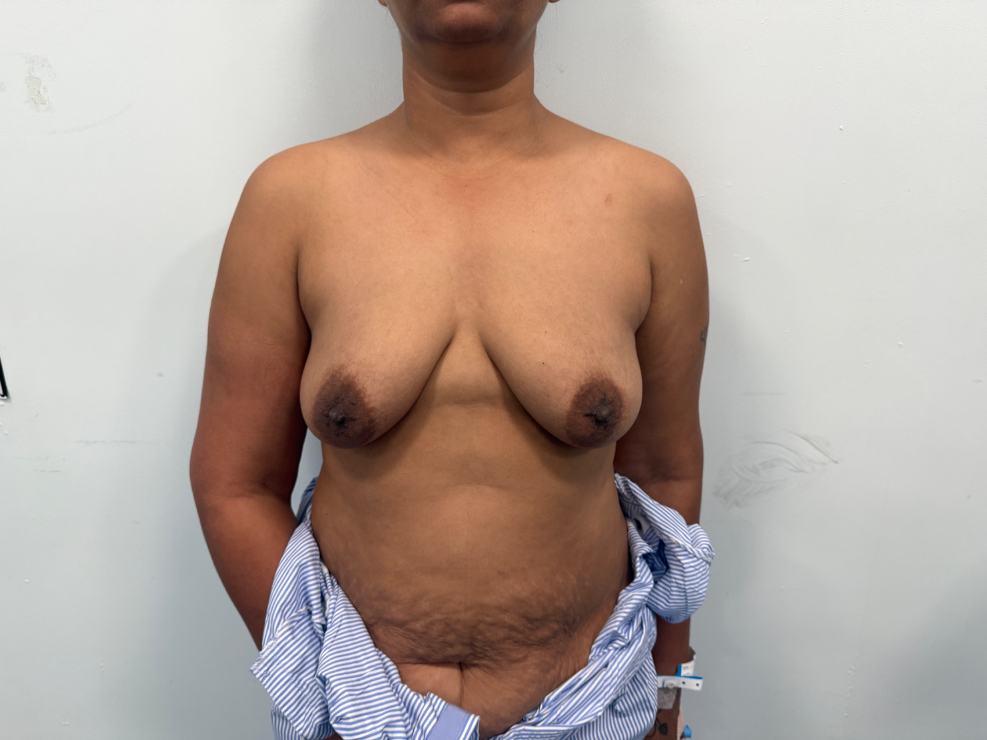 Ideal candidate for Mastopexy / Breast lift