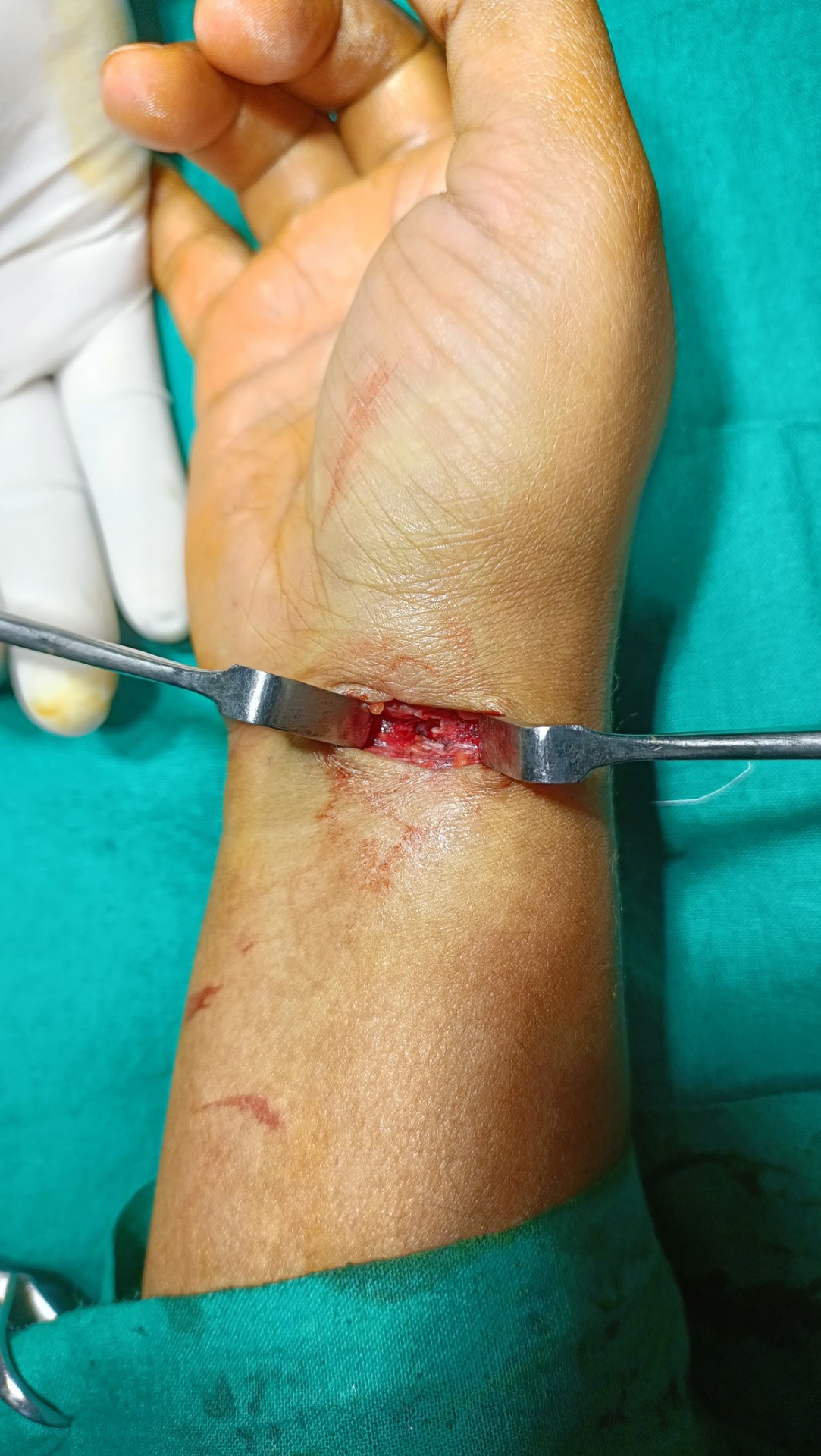 Complete excision done to avoid recurrence 