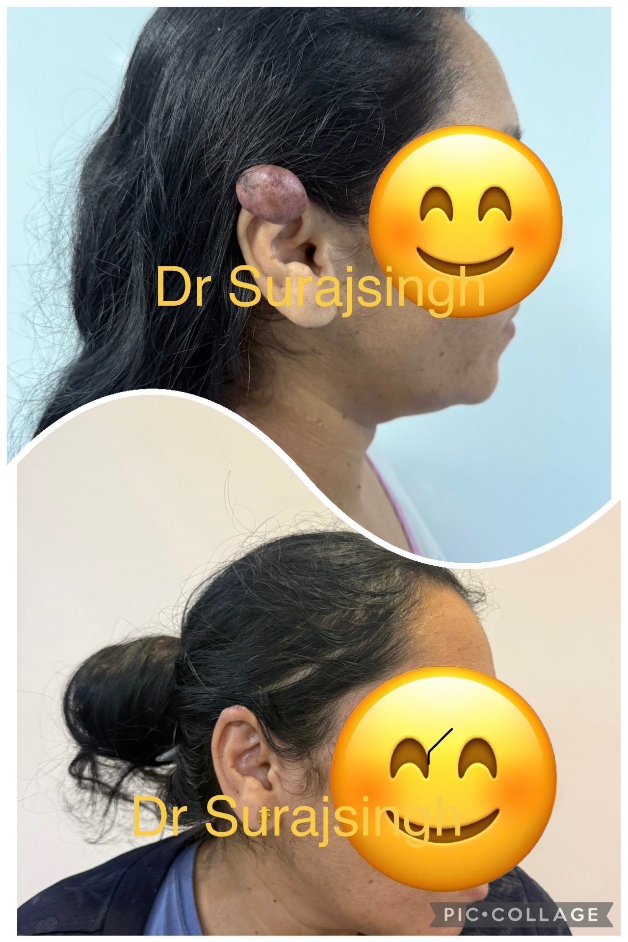 Ear keloids surgery gives best results 