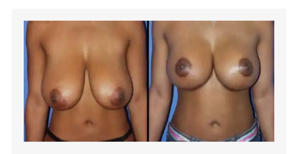 Before & After Results